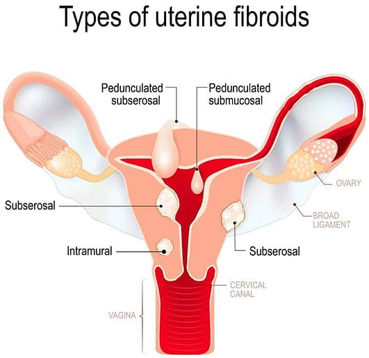 Drstitt Types of Fibroids optimized e