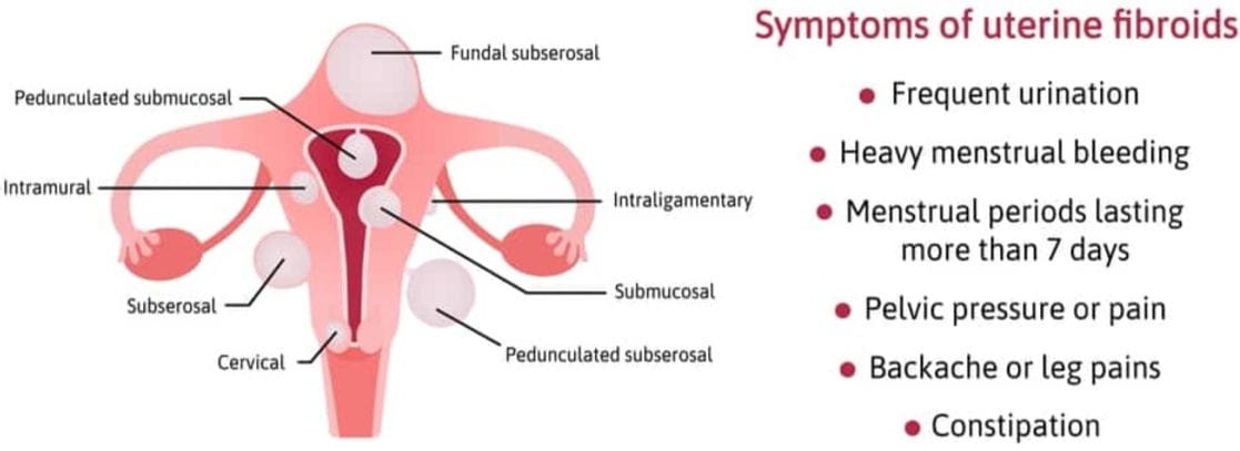 symptoms of fibroids optimized edited